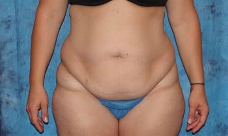 Tummy Tuck Jacksonville