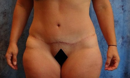 Abdominoplasty Jacksonville