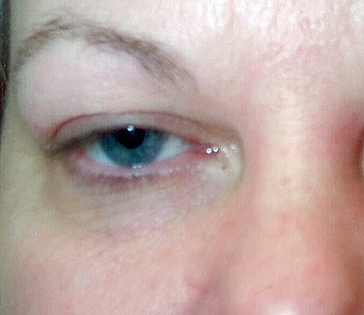 Eyelid Surgery Jacksonville