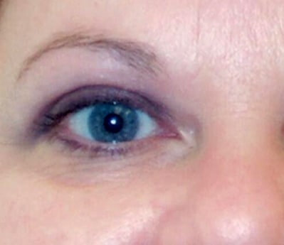 Blepharoplasty Jacksonville