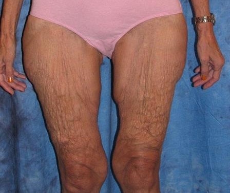 before Inner Thigh Lift Jacksonville FL