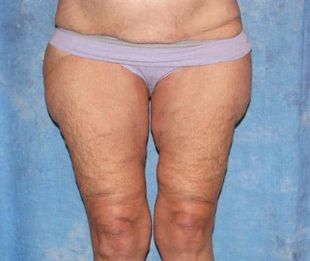 after Inner Thigh Lift Jacksonville FL