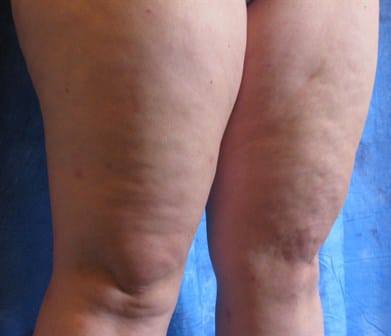 before Cellulaze Jacksonville FL