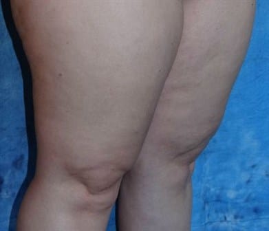 after Cellulaze Jacksonville FL