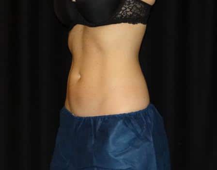 after CoolSculpting Jacksonville FL
