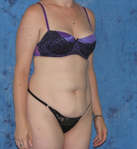 Mini Tummy Tuck Jacksonville