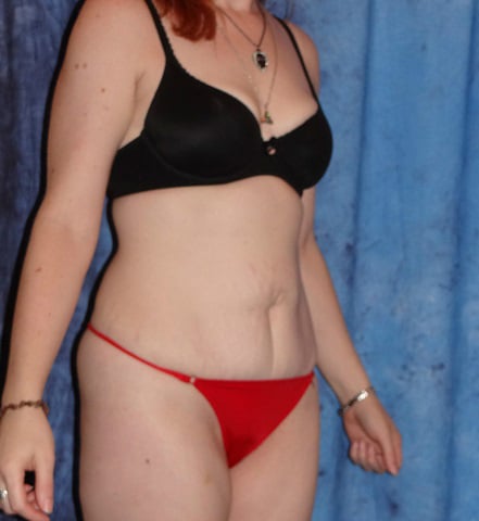 Mini Tummy Tuck Surgeon Jacksonville