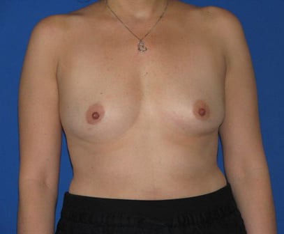 Breast Augmentation Jacksonville