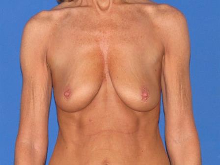 Breast Lift Jacksonville