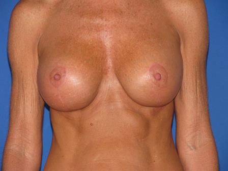 Breast Lift with Implants Jacksonville