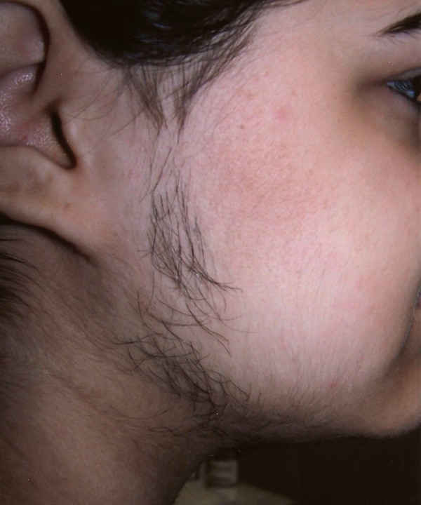 Before Laser Hair Removal Jacksonville FL