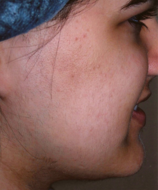 after Laser Hair Removal Jacksonville FL
