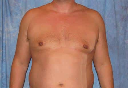 Male Breast Reduction Jacksonville