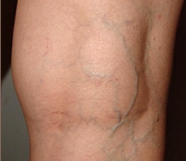 Before Leg Veins Treatment Jacksonville FL