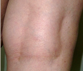 After Leg Veins Treatment Jacksonville FL