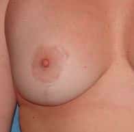 Scar Revision Surgery Jacksonville