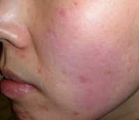 Before Pixel Laser Skin Rejuvenation Jacksonville FL