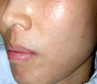 After Pixel Laser Skin Rejuvenation Jacksonville FL