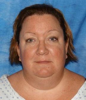 Laser Facelift Jacksonville