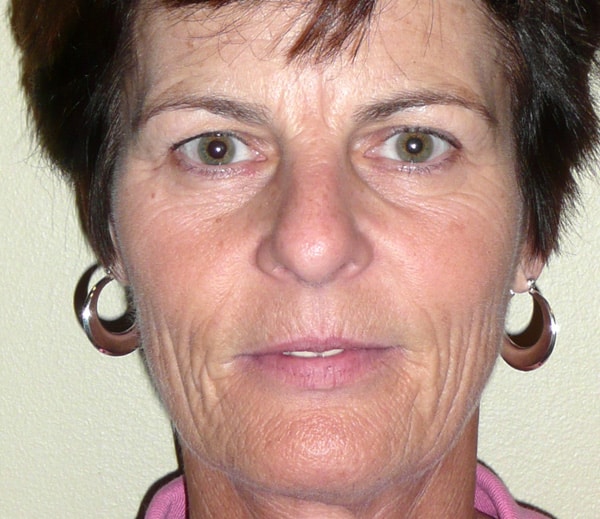 before Sculptra Jacksonville FL