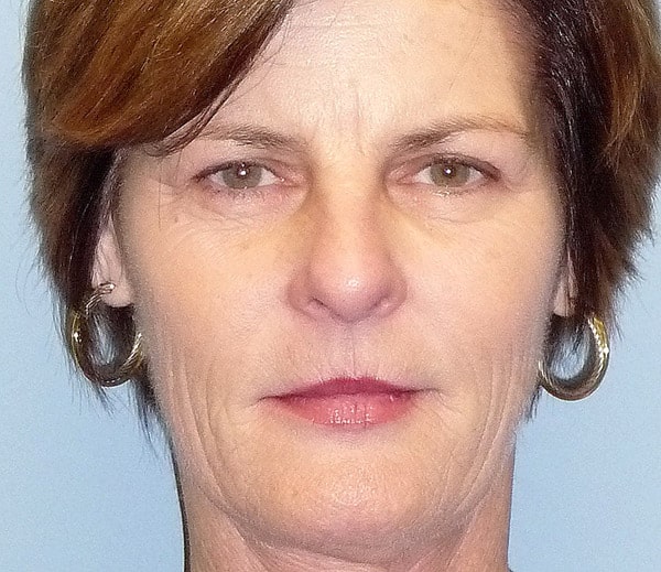 after Sculptra Jacksonville FL