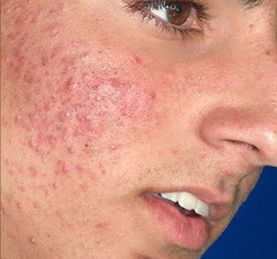 before IPL Treatment Jacksonville FL