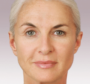 after Juvederm Jacksonville FL