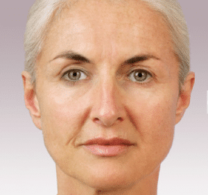 before Juvederm Jacksonville FL