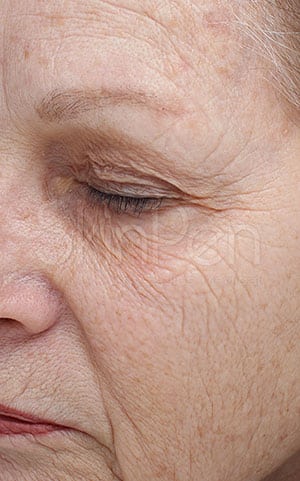Microneedling Jacksonville