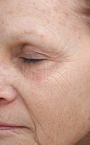 Vampire Facial Treatment Jacksonville