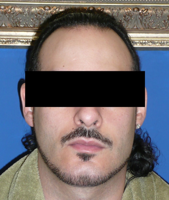 Chin Implant Jacksonville