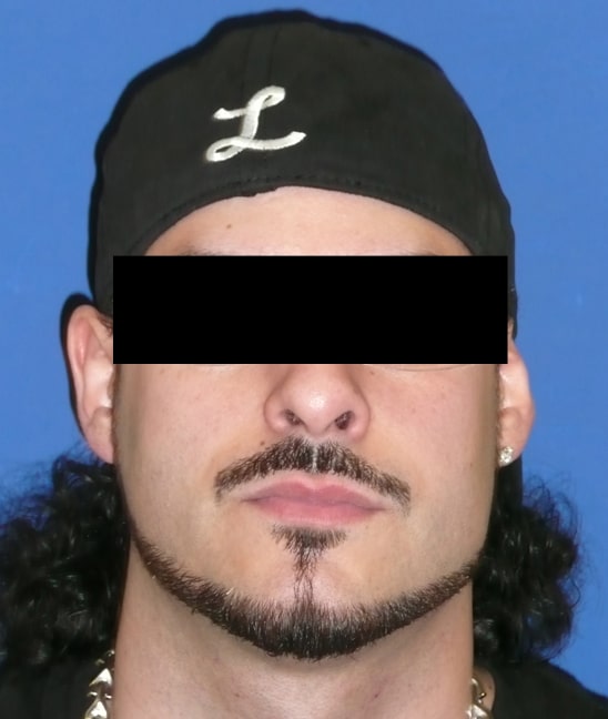 Chin Augmentation Jacksonville