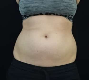 before VASER Liposuction Jacksonville FL