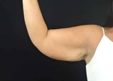 Upper Arm Lift Jacksonville