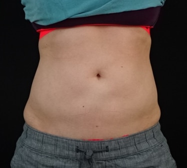 after VASER Liposuction Jacksonville FL