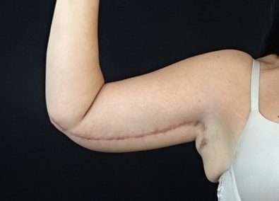 Brachioplasty Jacksonville
