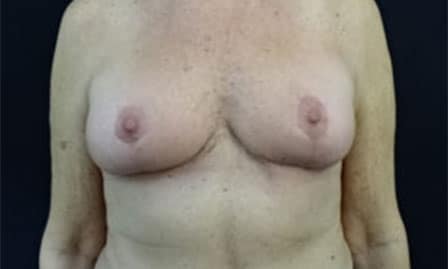 Breast Explant Surgeon Jacksonville