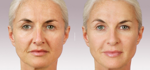 before and after juvederm injectable at posh plastic surgery in jacksonville