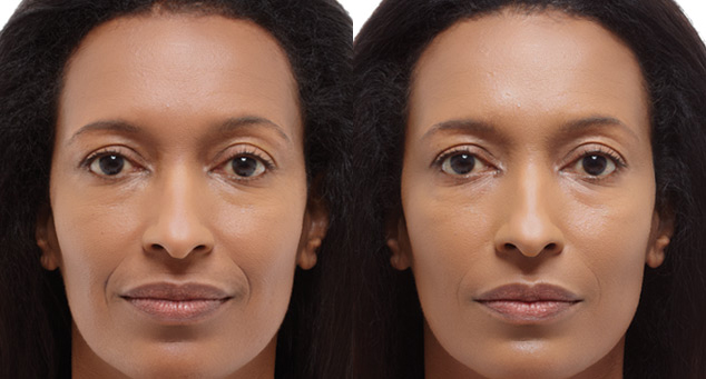 before and after radiesse injectable at posh plastic surgery in jacksonville
