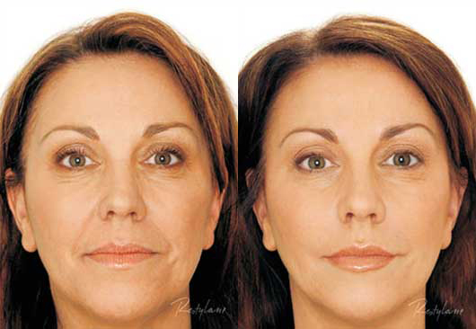 before and after restylane injectable at posh plastic surgery in jacksonville
