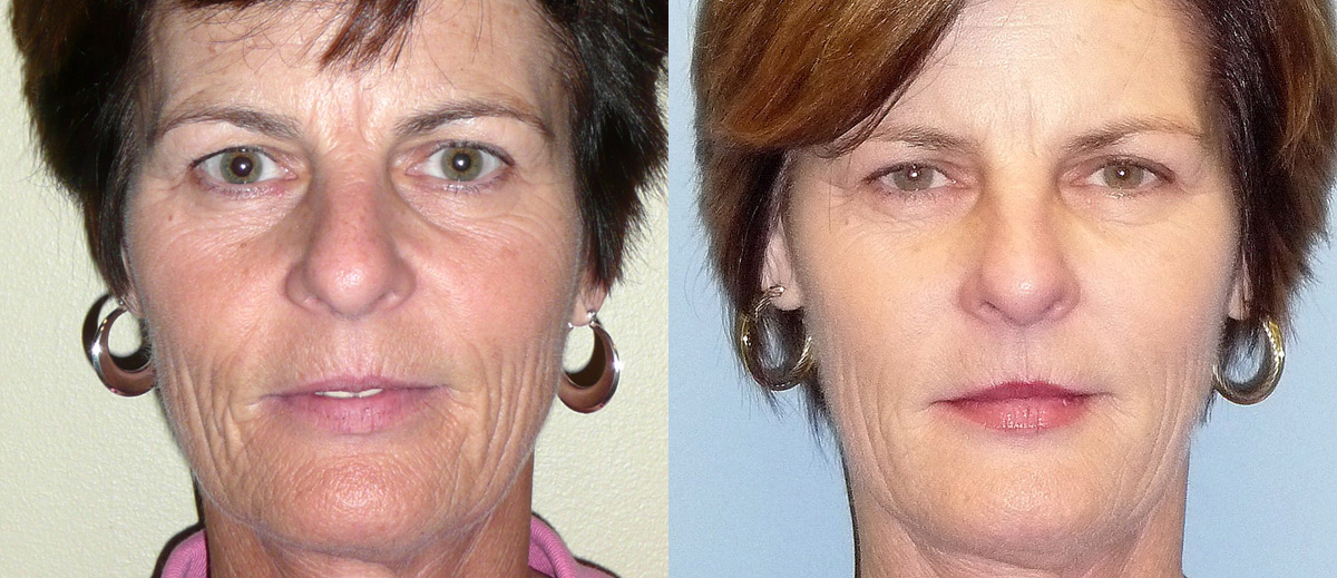 before and after sculptra injectable at posh plastic surgery in jacksonville