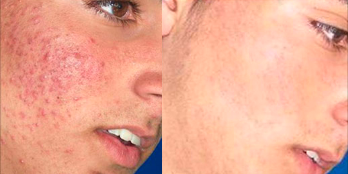 Posh Plastic Surgery IPL Before and After Results