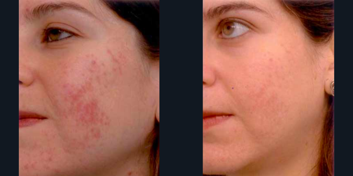 Posh Plastic Surgery IPL Before and After Results