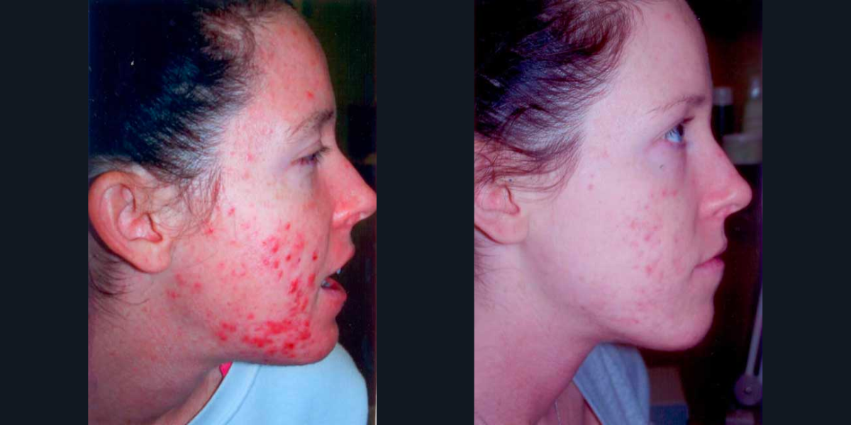 Posh Plastic Surgery IPL Before and After Results