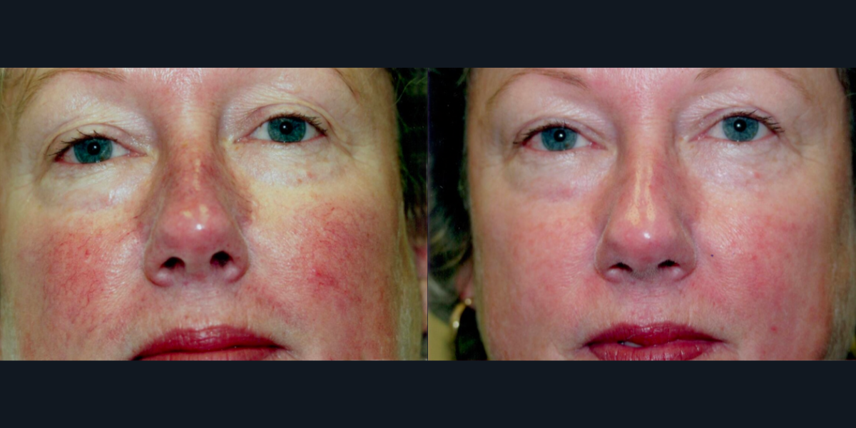 Posh Plastic Surgery IPL Before and After Results