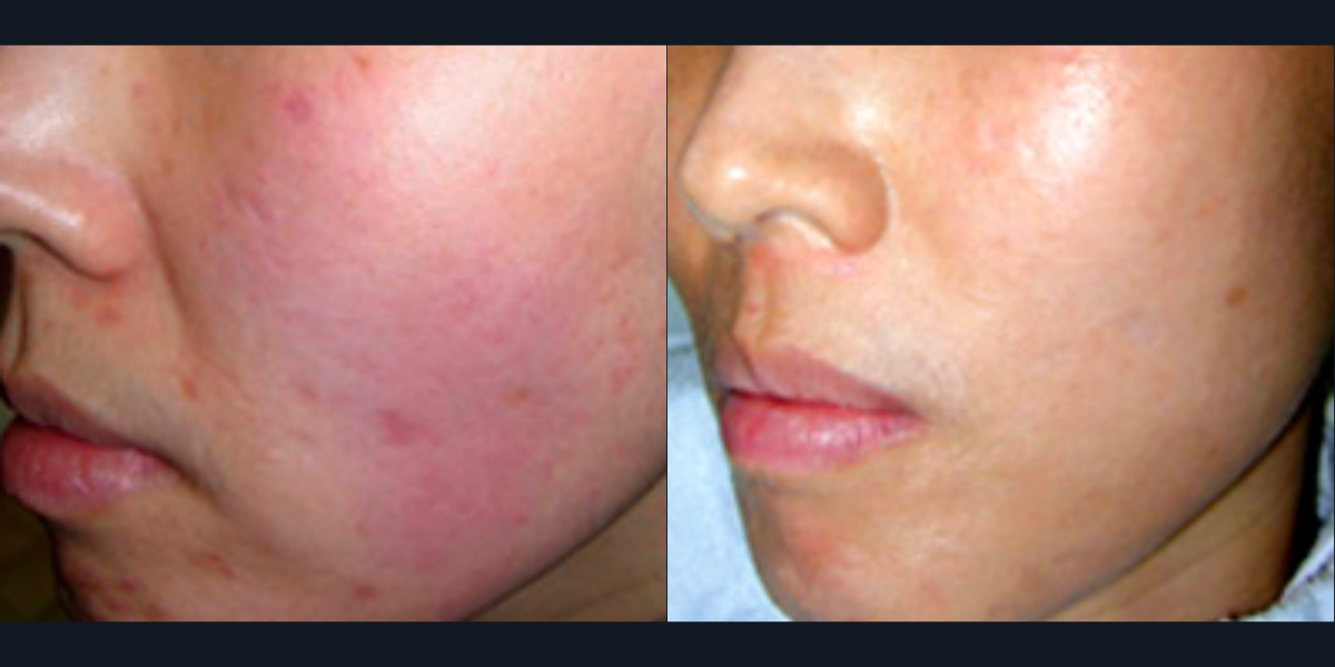 Posh Plastic Surgery Pixel Before and After Results