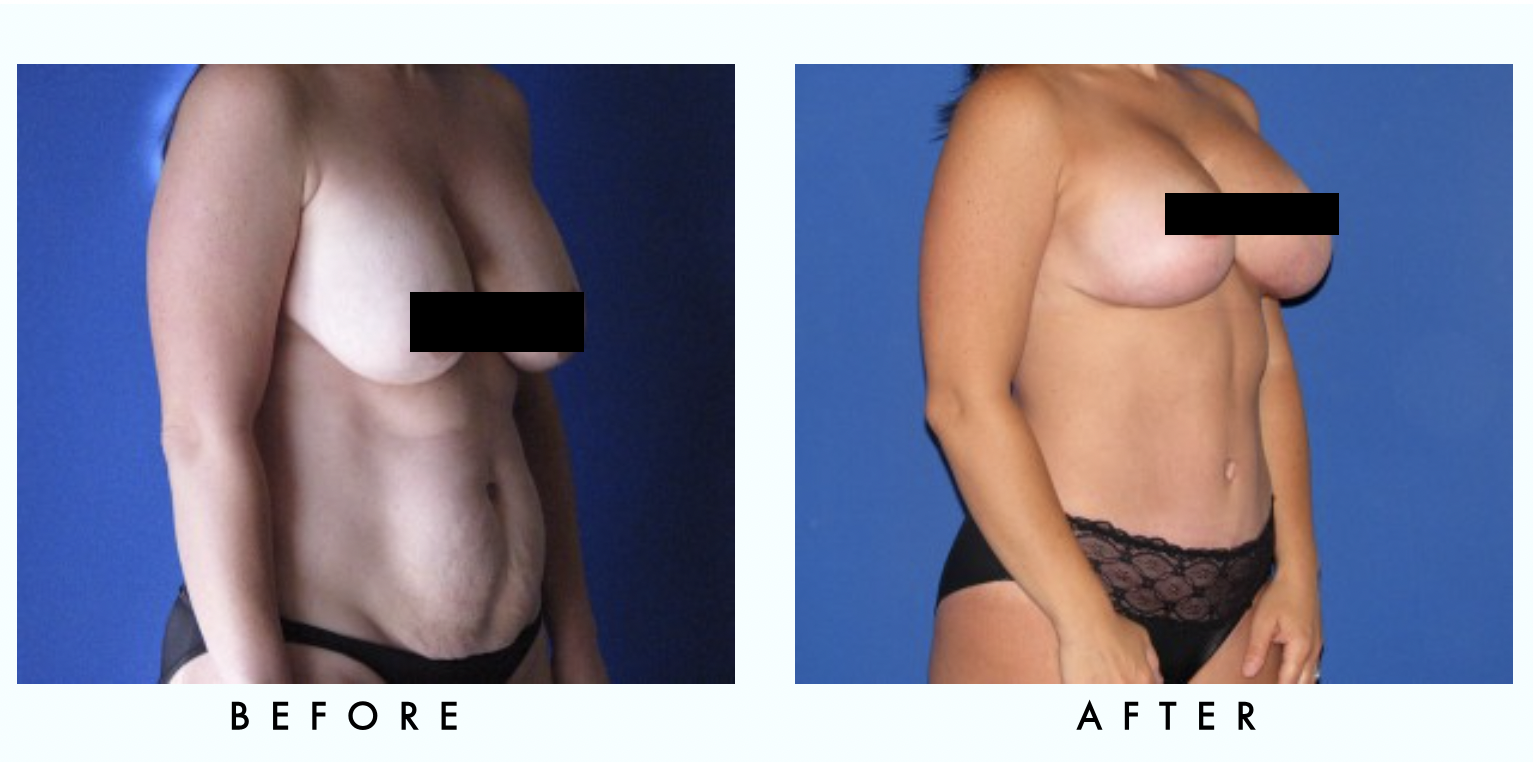 Before After Before After